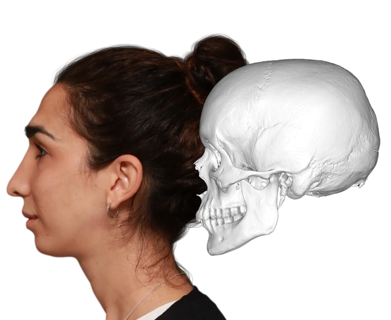 Comparison before and after forehead feminization surgery showing the results both on the exterior as on the bone level before surgery from the side.