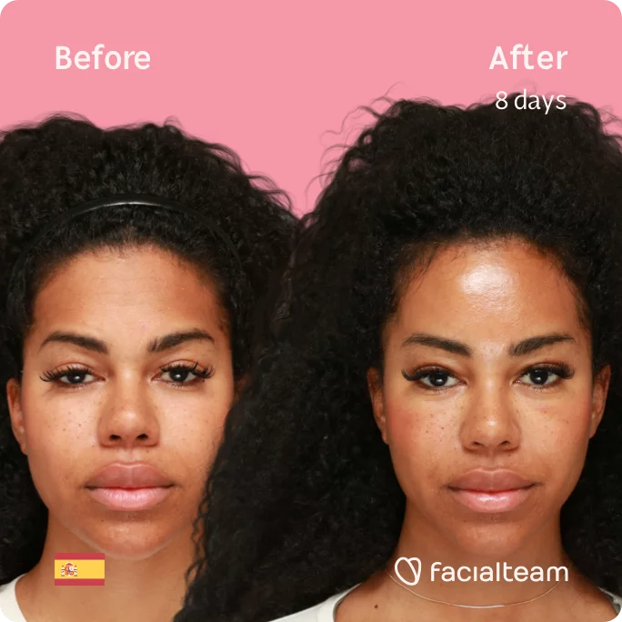 Square frontal image of FFS patient Alejandra showing the results before and after facial feminization surgery with Facialteam consisting of forehead feminization surgery.