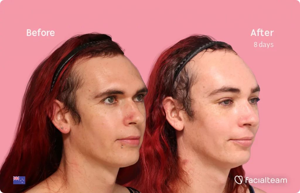 45 degree image of FFS patient Chloe showing the results before and after facial feminization surgery consisting of forehead feminization surgery.