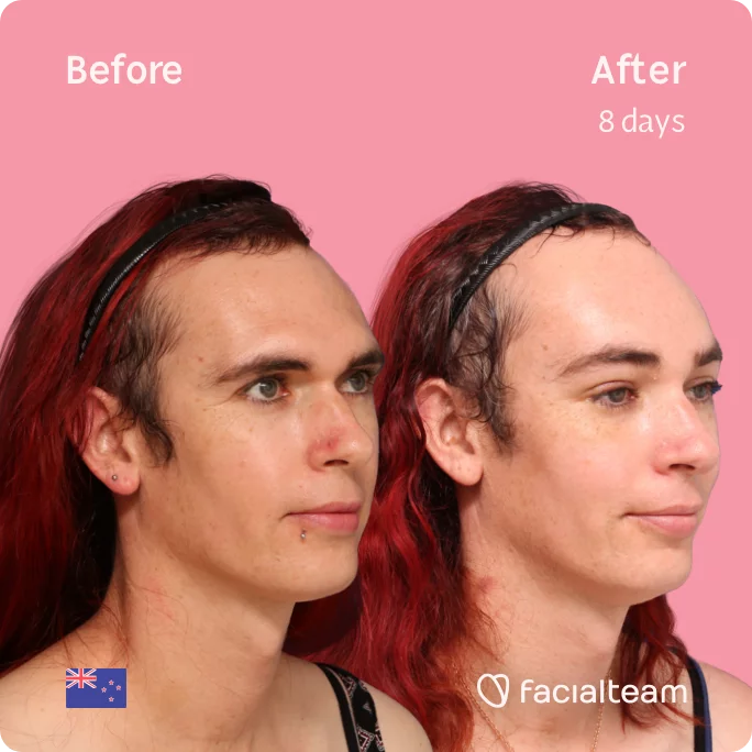 Square 45 degree image of FFS patient Chloe showing the results before and after facial feminization surgery consisting of forehead feminization surgery.