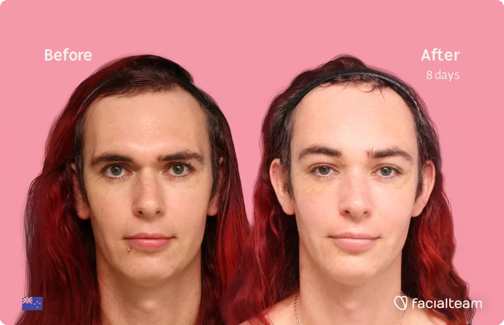 Frontal image of FFS patient Chloe showing the results before and after facial feminization surgery with Facialteam consisting of forehead feminization surgery.