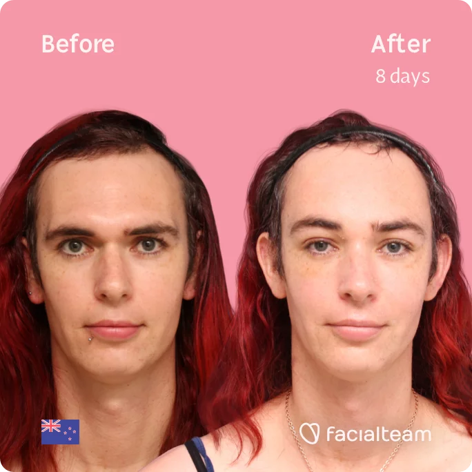Square frontal image of FFS patient Chloe showing the results before and after facial feminization surgery with Facialteam consisting of forehead feminization surgery.