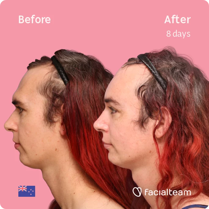 Square Side image of FFS patient Chloe showing the results before and after facial feminization surgery with Facialteam consisting of forehead feminization surgery.