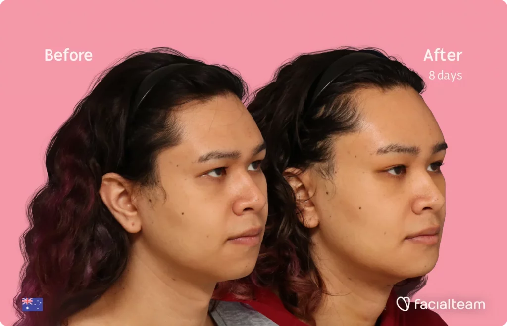 45 degree image of FFS patient Sienna showing the results before and after facial feminization surgery consisting of tracheal shave, forehead, chin feminization surgery.