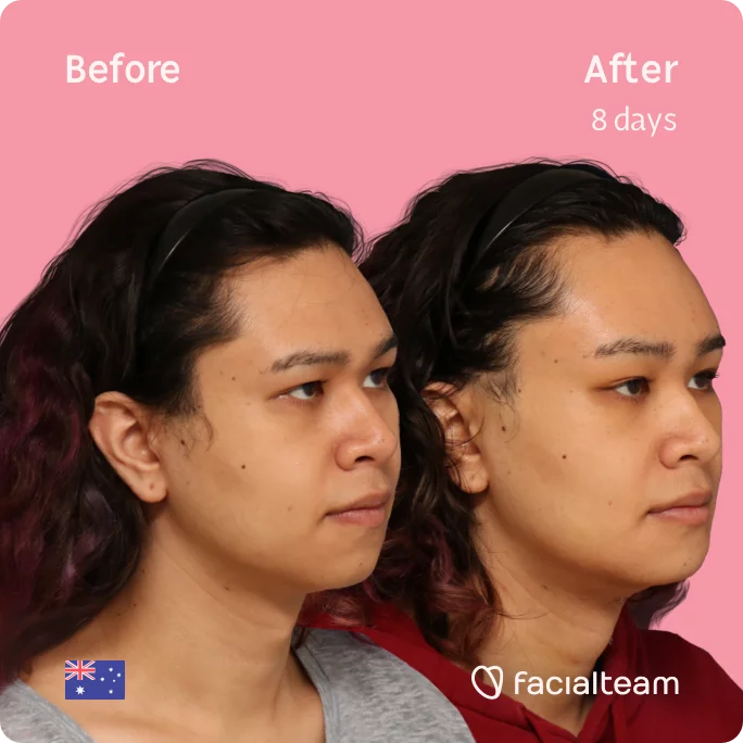 Square 45 degree image of FFS patient Sienna showing the results before and after facial feminization surgery consisting of tracheal shave, forehead, chin feminization surgery.
