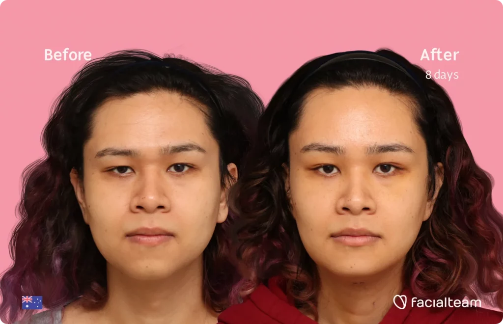 Frontal image of FFS patient Sienna showing the results before and after facial feminization surgery with Facialteam consisting of tracheal shave, forehead, chin feminization surgery.