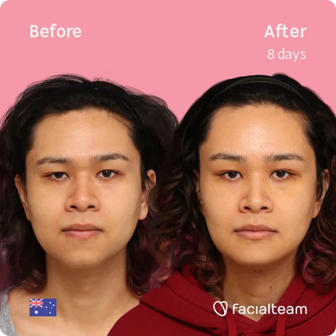 Side image of FFS patient Sienna showing the results before and after facial feminization surgery with Facialteam consisting of tracheal shave, forehead, chin feminization surgery.