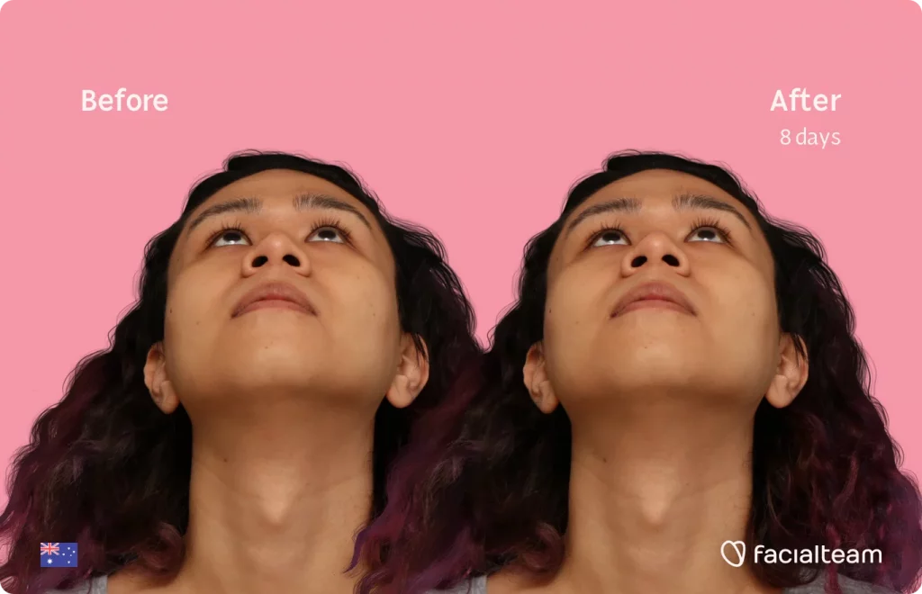 Image of FFS patient Sienna looking up showing the results before and after facial feminization surgery with Facialteam consisting of tracheal shave, forehead, chin feminization surgery.