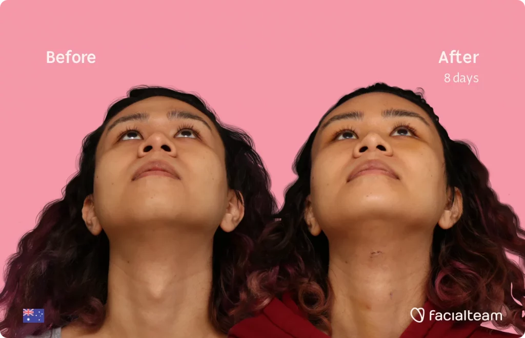 Frontal image of FFS patient Sienna looking up showing the results before and after facial feminization surgery with Facialteam consisting of tracheal shave, forehead, chin feminization surgery.