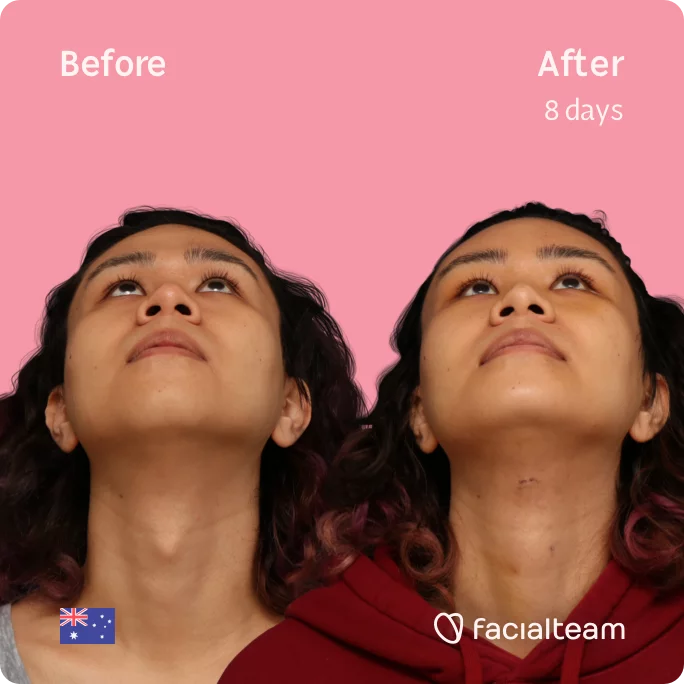 Square image of FFS patient Sienna looking up showing the results before and after facial feminization surgery with Facialteam consisting of tracheal shave, forehead, chin feminization surgery.