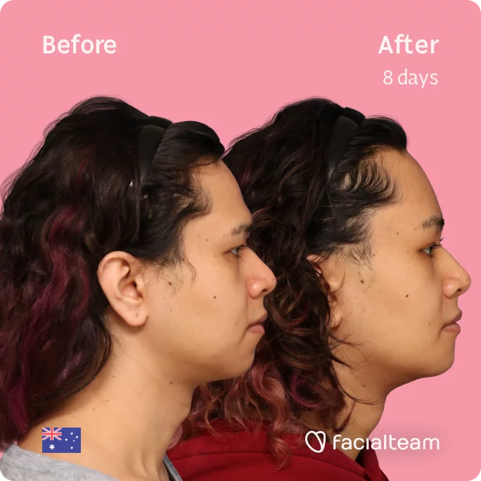 Square Side image of FFS patient Sienna showing the results before and after facial feminization surgery with Facialteam consisting of tracheal shave, forehead, chin feminization surgery.