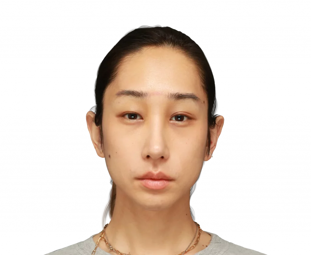 Frontal picture taken from Eunsoo after surgery