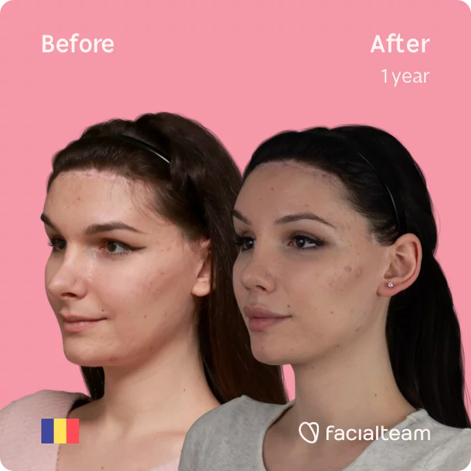 Square 45 degree image from left side of FFS patient Daria Jane showing the results before and after facial feminization surgery consisting of forehead feminization surgery.