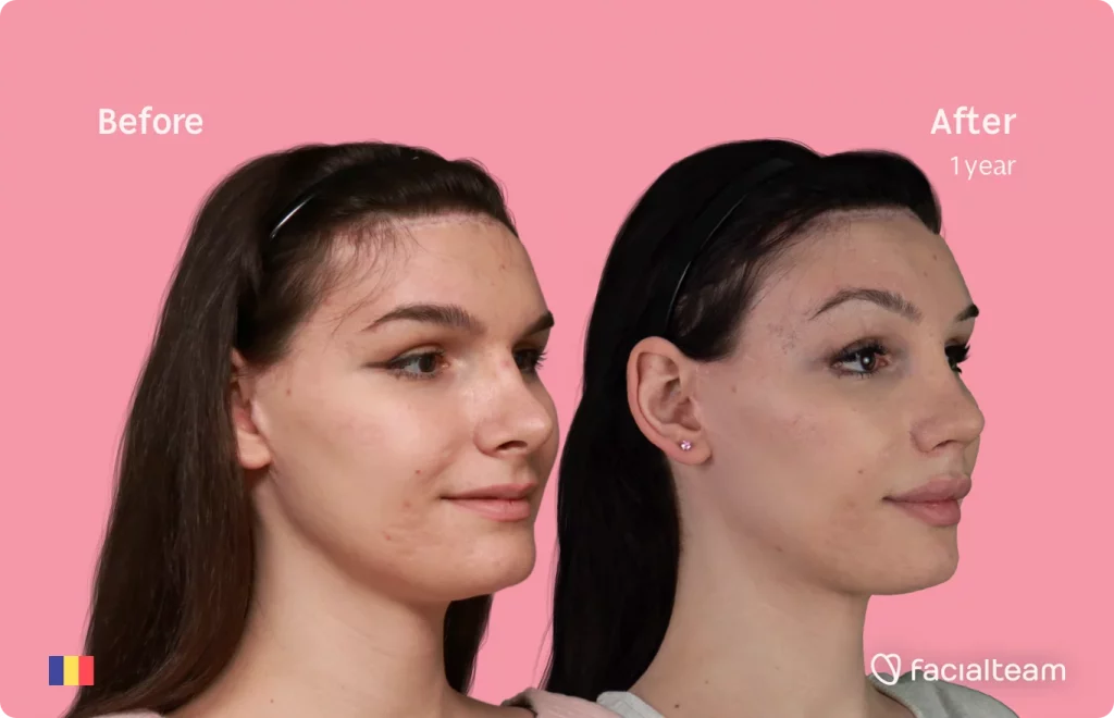 45 degree image from right of FFS patient Daria Jane showing the results before and after facial feminization surgery consisting of forehead feminization surgery.
