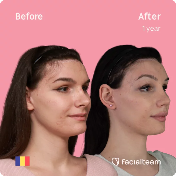 Square 45 degree image of FFS patient Daria Jane showing the results before and after facial feminization surgery consisting of forehead feminization surgery.