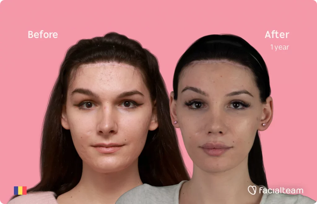 Frontal image of FFS patient Daria Jane showing the results before and after facial feminization surgery with Facialteam consisting of forehead feminization surgery.