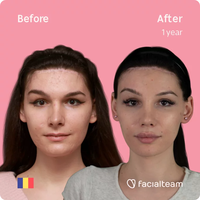 Square frontal image of FFS patient Daria Jane showing the results before and after facial feminization surgery with Facialteam consisting of forehead feminization surgery.