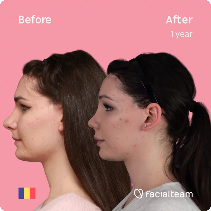 Square Side image of FFS patient Daria Jane showing the results before and after facial feminization surgery with Facialteam consisting of forehead feminization surgery.