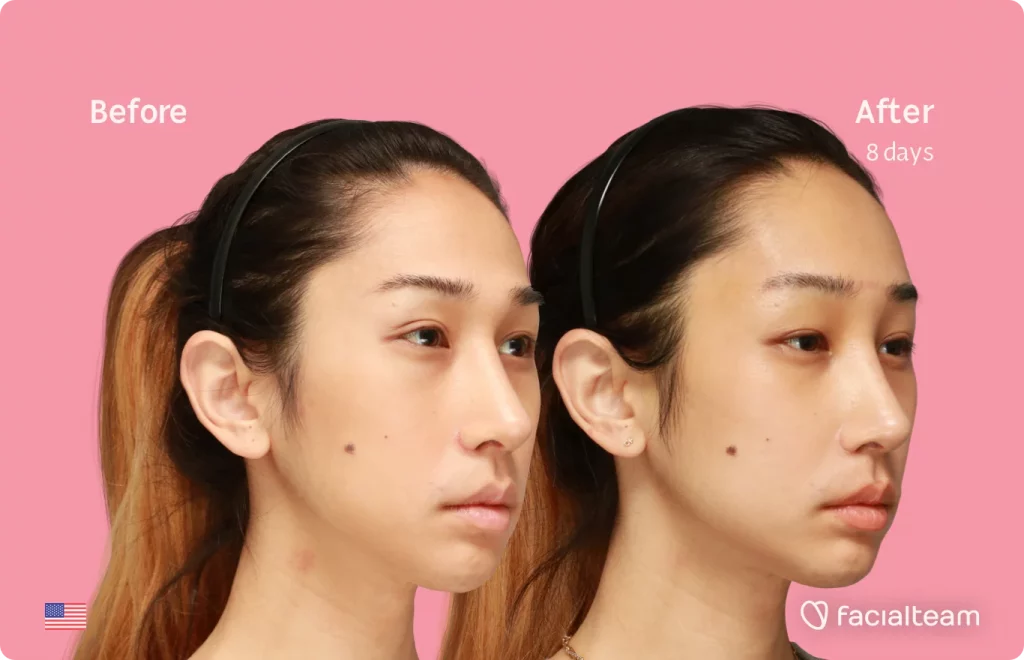 45 degree image of FFS patient Eunsoo showing the results before and after facial feminization surgery consisting of forehead feminization surgery.