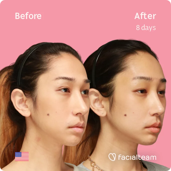 Square 45 degree image of FFS patient Eunsoo showing the results before and after facial feminization surgery consisting of forehead feminization surgery.