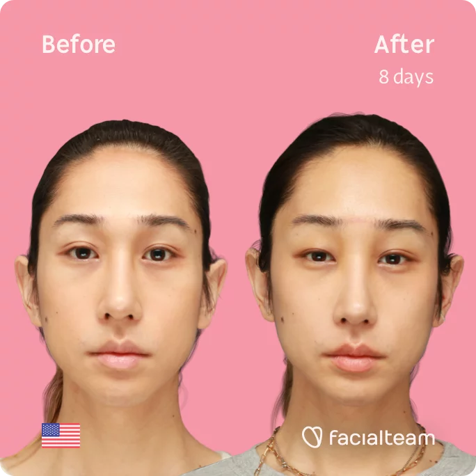 Square frontal image of FFS patient Eunsoo showing the results before and after facial feminization surgery with Facialteam consisting of forehead feminization surgery.