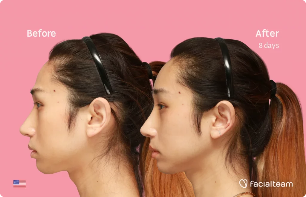 Side image of FFS patient Eunsoo showing the results before and after facial feminization surgery with Facialteam consisting of forehead feminization surgery.