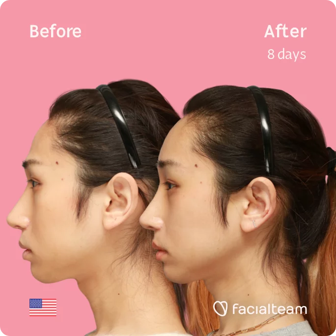 Square Side image of FFS patient Eunsoo showing the results before and after facial feminization surgery with Facialteam consisting of forehead feminization surgery.