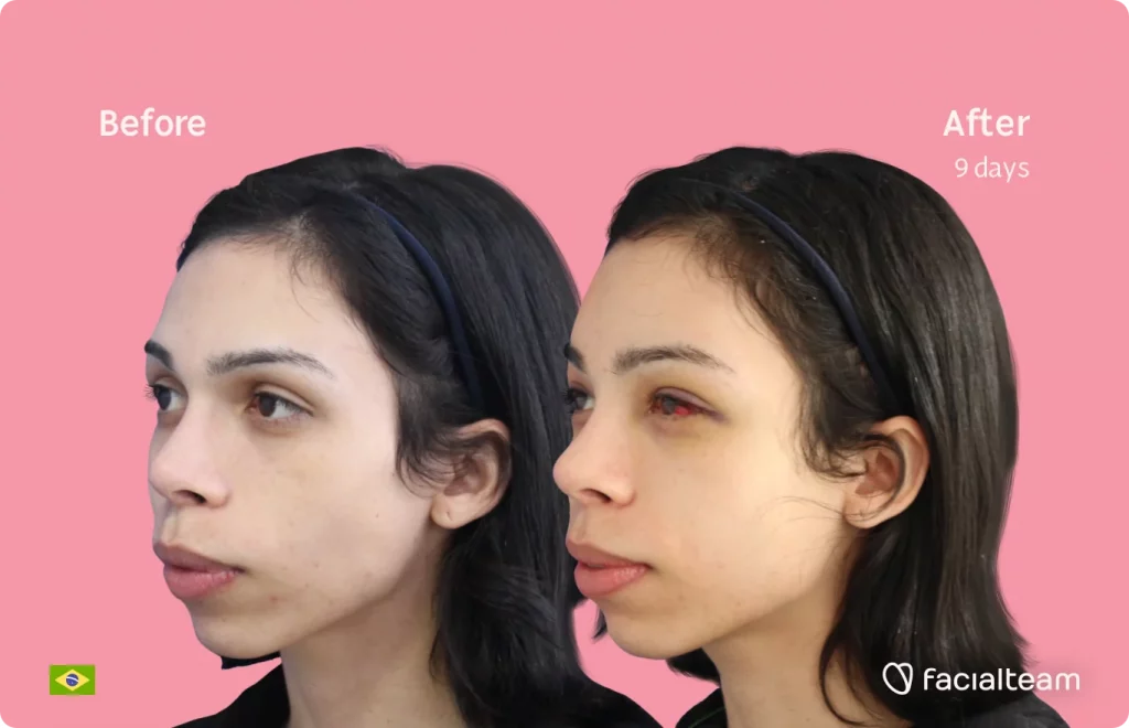 45 degree image of FFS patient Kalye showing the results before and after facial feminization surgery consisting of forehead feminization surgery.