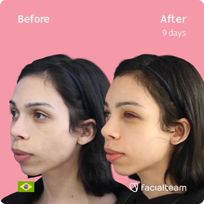 Square 45 degree image of FFS patient Kalye showing the results before and after facial feminization surgery consisting of forehead feminization surgery.