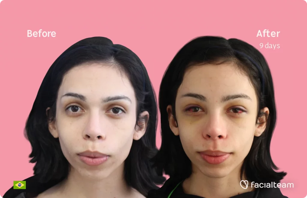 Frontal image of FFS patient Kalye showing the results before and after facial feminization surgery with Facialteam consisting of forehead feminization surgery.
