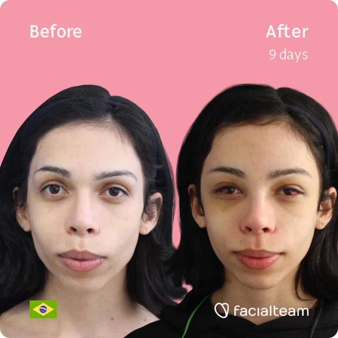 Square frontal image of FFS patient Kalye showing the results before and after facial feminization surgery with Facialteam consisting of forehead feminization surgery.