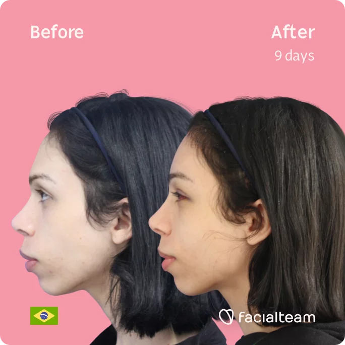Square Side image of FFS patient Kalye showing the results before and after facial feminization surgery with Facialteam consisting of forehead feminization surgery.