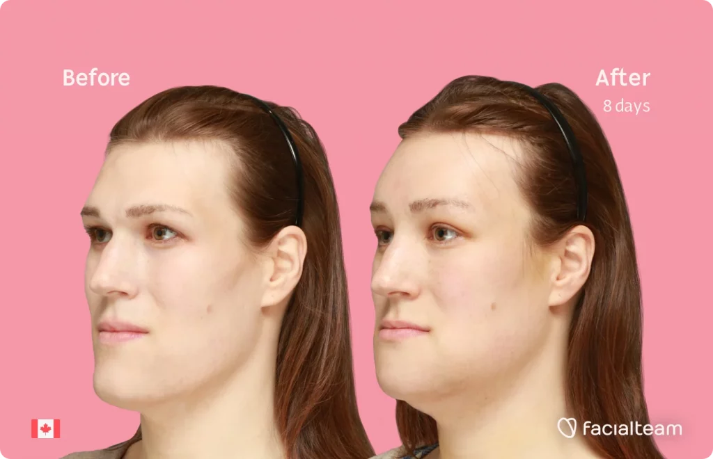 45 degree image from the left of FFS patient Gwendolyn showing the results before and after facial feminization surgery consisting of forehead, chin, forehead with SHT, jaw feminization surgery.