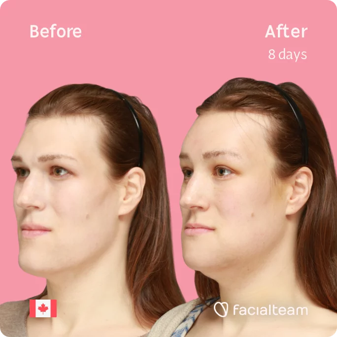 Square 45 degree image from the left of FFS patient Gwendolyn showing the results before and after facial feminization surgery consisting of forehead, chin, forehead with SHT, jaw feminization surgery.