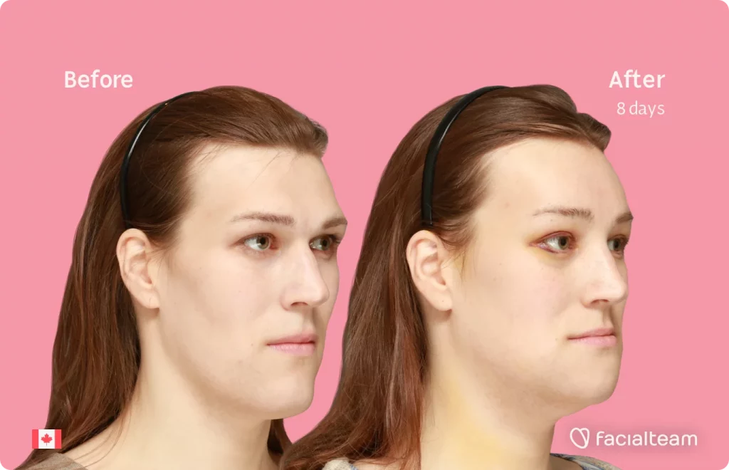45 degree image from the right of FFS patient Gwendolyn showing the results before and after facial feminization surgery consisting of forehead, chin, forehead with SHT, jaw feminization surgery.