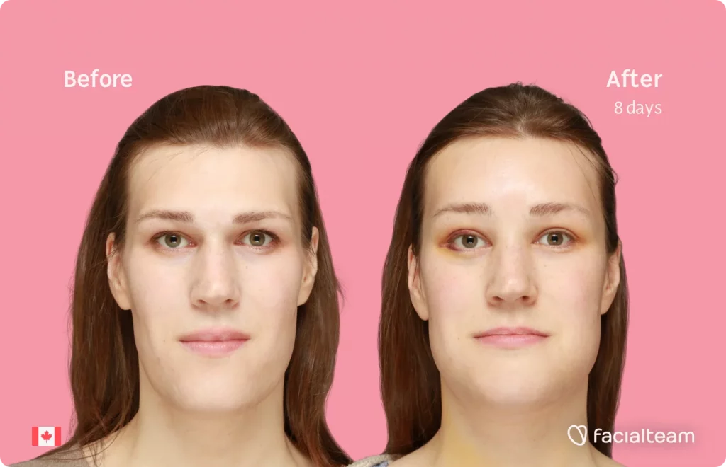 Frontal image of FFS patient Gwendolyn showing the results before and after facial feminization surgery with Facialteam consisting of forehead, chin, forehead with SHT, jaw feminization surgery.