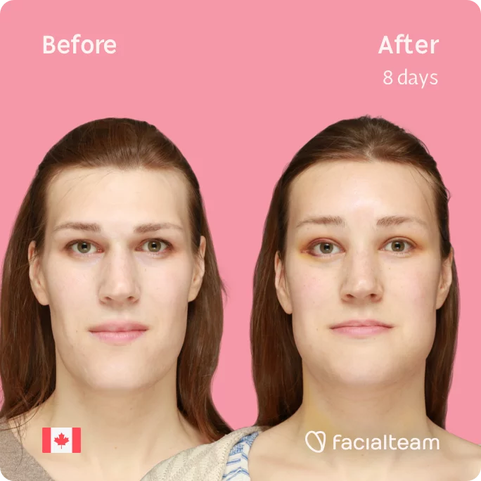 Square frontal image of FFS patient Gwendolyn showing the results before and after facial feminization surgery with Facialteam consisting of forehead, chin, forehead with SHT, jaw feminization surgery.