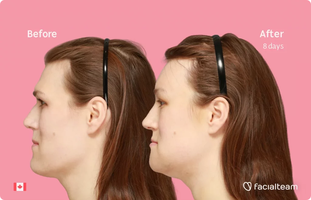 Side image of FFS patient Gwendolyn showing the results before and after facial feminization surgery with Facialteam consisting of forehead, chin, forehead with SHT, jaw feminization surgery.
