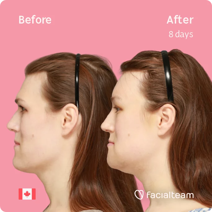 Square Side image of FFS patient Gwendolyn showing the results before and after facial feminization surgery with Facialteam consisting of forehead, chin, forehead with SHT, jaw feminization surgery.