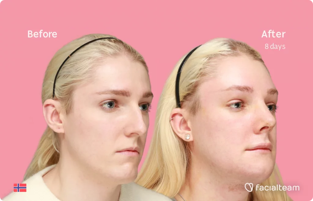 45 degree image of FFS patient Sara showing the results before and after facial feminization surgery consisting of tracheal shave, rhinoplasty, chin, jaw feminization surgery.
