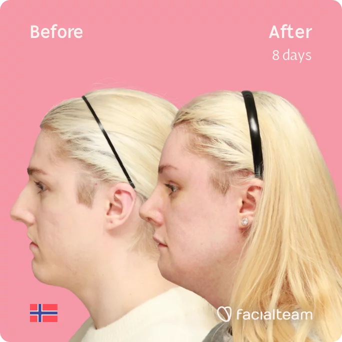 Square Side image of FFS patient Sara showing the results before and after facial feminization surgery with Facialteam consisting of tracheal shave, rhinoplasty, chin, jaw feminization surgery.