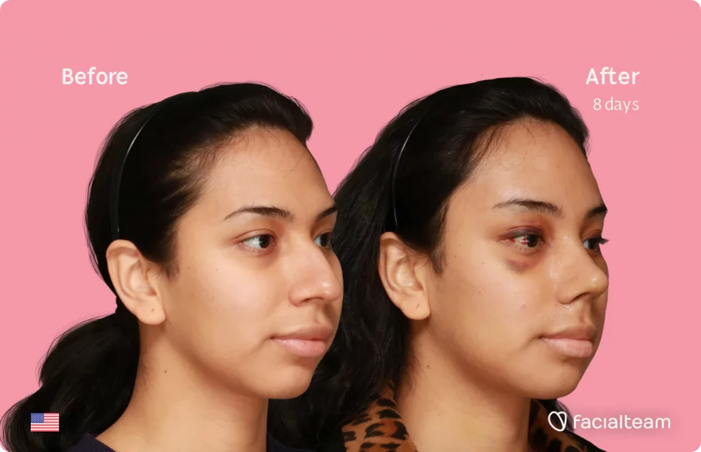 45 degree image of FFS patient Angel showing the results before and after facial feminization surgery consisting of forehead, rhinoplasty, jaw, chin feminization surgery.