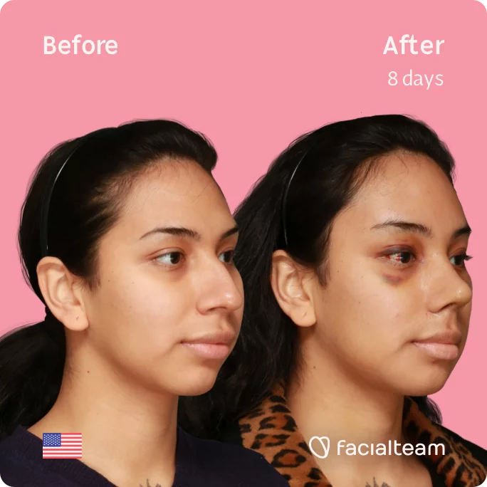 Square 45 degree image of FFS patient Angel showing the results before and after facial feminization surgery consisting of forehead, rhinoplasty, jaw, chin feminization surgery.