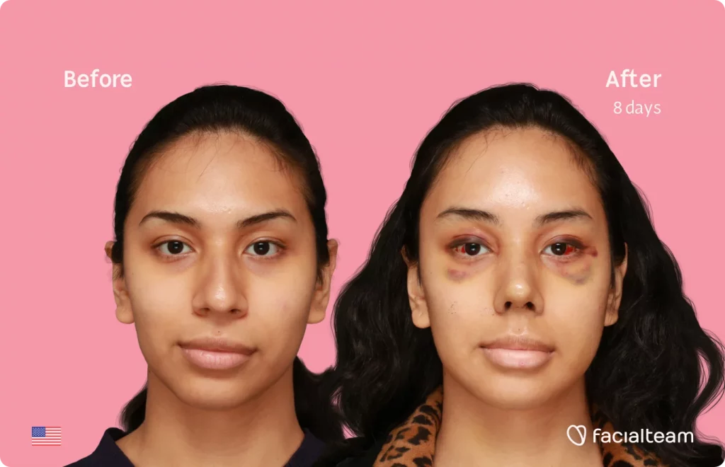 Frontal image of FFS patient Angel showing the results before and after facial feminization surgery with Facialteam consisting of forehead, rhinoplasty, jaw, chin feminization surgery.