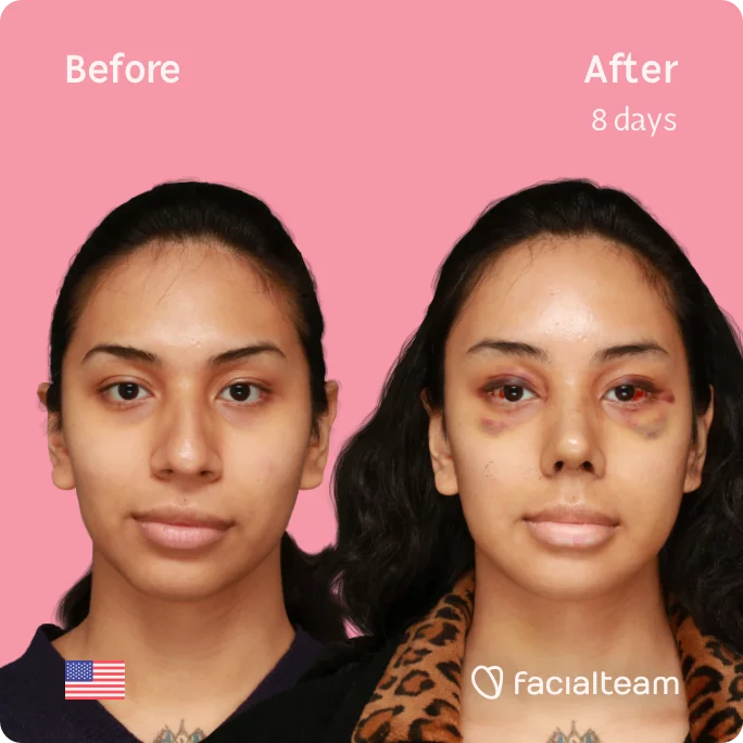 Square frontal image of FFS patient Angel showing the results before and after facial feminization surgery with Facialteam consisting of forehead, rhinoplasty, jaw, chin feminization surgery.