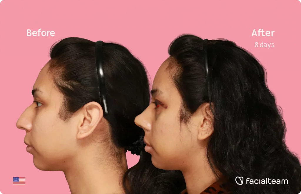 Side image of FFS patient Angel showing the results before and after facial feminization surgery with Facialteam consisting of forehead, rhinoplasty, jaw, chin feminization surgery.