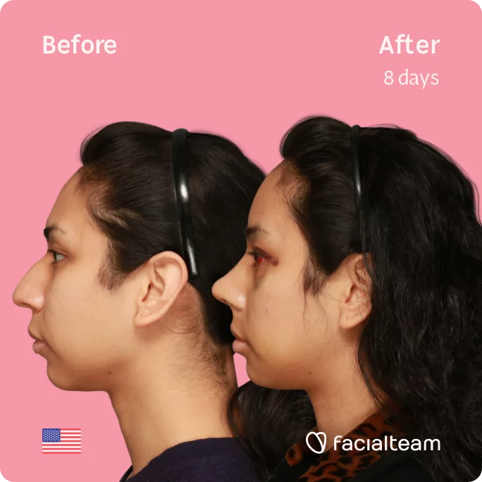 Square Side image of FFS patient Angel showing the results before and after facial feminization surgery with Facialteam consisting of forehead, rhinoplasty, jaw, chin feminization surgery.
