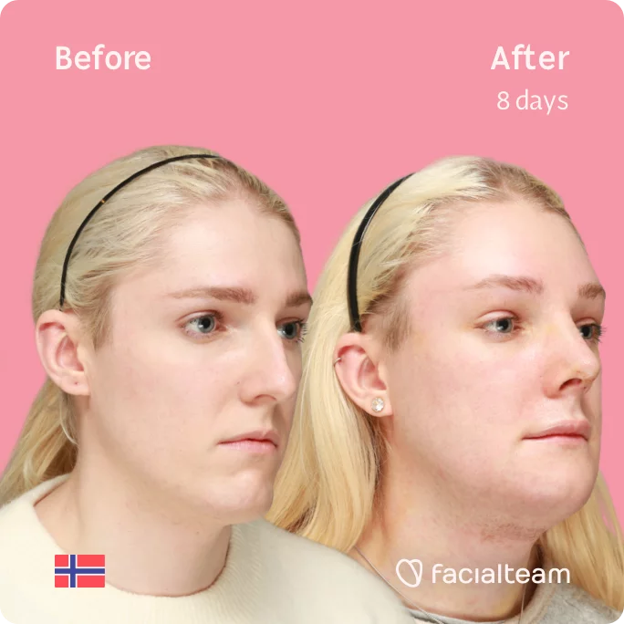 Square 45 degree image of FFS patient Sara showing the results before and after facial feminization surgery consisting of tracheal shave, rhinoplasty, chin, jaw feminization surgery.