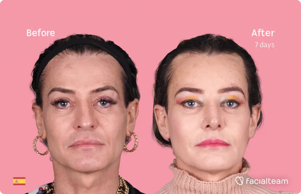 Frontal image of FFS patient Paris showing the results before and after facial feminization surgery with Facialteam consisting of forehead, rhinoplasty feminization surgery.