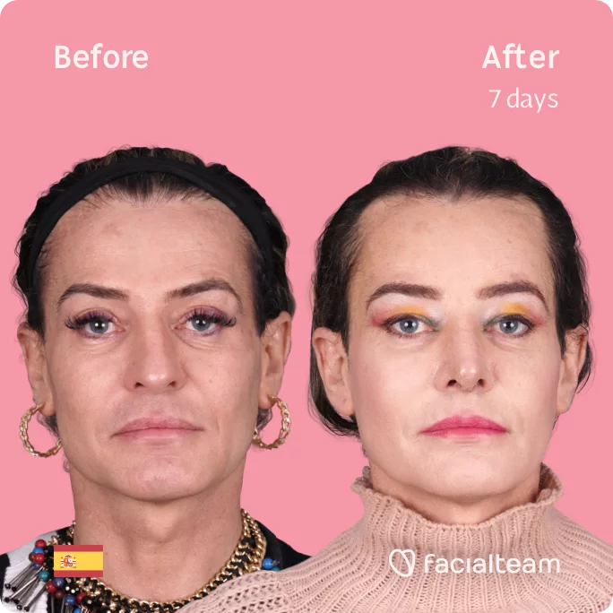 Square frontal image of FFS patient Paris showing the results before and after facial feminization surgery with Facialteam consisting of forehead, rhinoplasty feminization surgery.